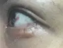 その他（目元） / 下まぶたたるみ取り / 下まぶたの脂肪取り / ヒアルロン酸注入（涙袋） ジュエリー美容外科 DAY 12 サムネイル用