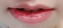 口唇縮小術 B-LINE CLINIC 池袋院 DAY 14 サムネイル用