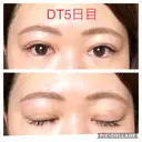 二重埋没 城本クリニック 四日市院 DAY 5 サムネイル用