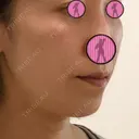 肌ヒアルロン酸注入（たるみ・シワ改善） / ヒアルロン酸注入（頬） 青山外苑前クリニック DAY 0 サムネイル用