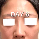 ヒアルロン酸注入（鼻） BIANCA銀座 DAY 6 サムネイル用