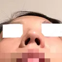 ヒアルロン酸注入（鼻） BIANCA銀座 DAY 6 サムネイル用