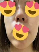 鼻尖形成（切開） / ヒアルロン酸注入（鼻） 東京ヒルズクリニック 新宿院 DAY 33 サムネイル用