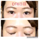 二重埋没 城本クリニック 四日市院 DAY 6 サムネイル用