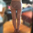 ボトックス（ふくらはぎ） / その他（ボディ） プチパーティー医院 DAY 246 サムネイル用