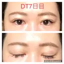 二重埋没 城本クリニック 四日市院 DAY 7 サムネイル用