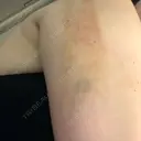 脂肪溶解注射（顔） / 脂肪溶解注射（二の腕） / ボトックス（肩） / その他（ボディ） 品川スキンクリニック京都院 DAY 3 サムネイル用