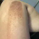 脂肪溶解注射（顔） / 脂肪溶解注射（二の腕） / ボトックス（肩） / その他（ボディ） 品川スキンクリニック京都院 DAY 3 サムネイル用