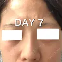 ヒアルロン酸注入（鼻） BIANCA銀座 DAY 7 サムネイル用