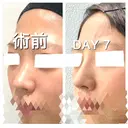 ヒアルロン酸注入（鼻） BIANCA銀座 DAY 7 サムネイル用