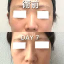 ヒアルロン酸注入（鼻） BIANCA銀座 DAY 7 サムネイル用