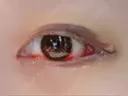 目頭切開 / 目尻切開 FROM B整形外科 (旧バウム整形外科) DAY 5 サムネイル用