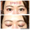 二重埋没 城本クリニック 四日市院 DAY 9 サムネイル用