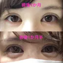 二重埋没 / 上まぶたの脂肪取り 東京ヒルズクリニック 新宿院 DAY 45 サムネイル用