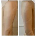 GLP-1ダイエット / 脂肪溶解注射（二の腕） / その他（ボディ） 湘南美容クリニック 新橋銀座口院 AFTER サムネイル用