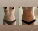 脂肪吸引（お腹） WOM CLINIC GINZA （ワム クリニック ギンザ） DAY 42 サムネイル用