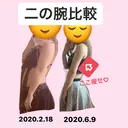 脂肪吸引（二の腕） ヨンセスリムライン AFTER サムネイル用