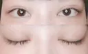 二重切開 / 目頭切開 / 上まぶたたるみ取り 湘南美容クリニック 金沢院 DAY 95 サムネイル用