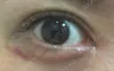 その他（目元） / 下まぶたたるみ取り / 下まぶたの脂肪取り / ヒアルロン酸注入（涙袋） ジュエリー美容外科 DAY 13 サムネイル用