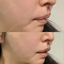 ヒアルロン酸溶解 / その他（口元） 六本木スキンクリニック DAY 2 サムネイル用