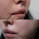 ヒアルロン酸溶解 / その他（口元） 六本木スキンクリニック DAY 4 サムネイル用