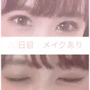 二重埋没 湘南美容クリニック 赤坂見附院 AFTER サムネイル用