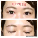 二重埋没 城本クリニック 四日市院 AFTER サムネイル用