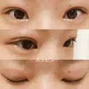 二重埋没 湘南美容クリニック 大阪堺東院 DAY 21 サムネイル用