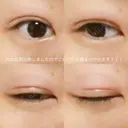 二重埋没 湘南美容クリニック 大阪堺東院 DAY 21 サムネイル用