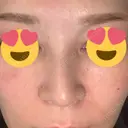 スレッドノーズ 品川スキンクリニック銀座院 DAY 6 サムネイル用