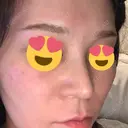 スレッドノーズ 品川スキンクリニック銀座院 DAY 6 サムネイル用