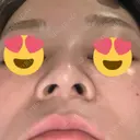 スレッドノーズ 品川スキンクリニック銀座院 DAY 6 サムネイル用