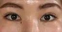 二重埋没 / 目頭切開 / 上まぶたの脂肪取り 湘南美容クリニック 京都院 AFTER サムネイル用