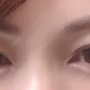 クマ治療 / ヒアルロン酸注入（涙袋） プラストクリニック AFTER サムネイル用