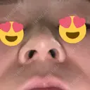 スレッドノーズ 品川スキンクリニック銀座院 DAY 7 サムネイル用