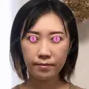 肌ヒアルロン酸注入（たるみ・シワ改善） / ヒアルロン酸注入（頬） 青山外苑前クリニック DAY 12 サムネイル用