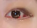 目頭切開 / 目尻切開 FROM B整形外科 (旧バウム整形外科) DAY 6 サムネイル用