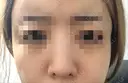 鼻尖形成（切開） / 鼻中隔延長（切開） / 骨切幅寄せ 韓国BBクリニック（旧 シンミアン形成外科） AFTER サムネイル用