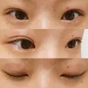 二重埋没 湘南美容クリニック 大阪堺東院 DAY 22 サムネイル用