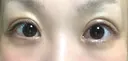 二重切開 / 目頭切開 ばん皮膚科 AFTER サムネイル用