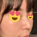 スレッドノーズ 品川スキンクリニック銀座院 DAY 10 サムネイル用