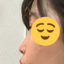 小鼻縮小（切開） / その他（鼻） 湘南メディカル記念病院（両国） DAY 14 サムネイル用