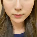 ハイフ（顔） Zetith Beauty Clinic 銀座院 DAY 22 サムネイル用