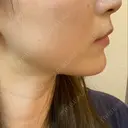 ハイフ（顔） Zetith Beauty Clinic 銀座院 DAY 22 サムネイル用