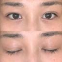 二重埋没 湘南美容クリニック 西宮北口院 DAY 20 サムネイル用