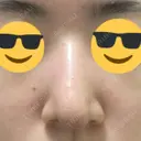 鼻尖縮小 / ヒアルロン酸注入（鼻） 東京ヒルズクリニック 新宿院 DAY 8 サムネイル用