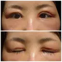 二重切開 / 目頭切開 / 眼瞼下垂（切開） / 目尻切開 湘南美容クリニック 大阪堺東院 DAY 7 サムネイル用