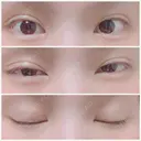 二重埋没 ビスポーククリニック 福岡院 AFTER サムネイル用