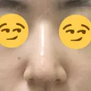 鼻尖縮小 / ヒアルロン酸注入（鼻） 東京ヒルズクリニック 新宿院 DAY 9 サムネイル用