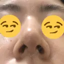 鼻尖縮小 / ヒアルロン酸注入（鼻） 東京ヒルズクリニック 新宿院 DAY 9 サムネイル用